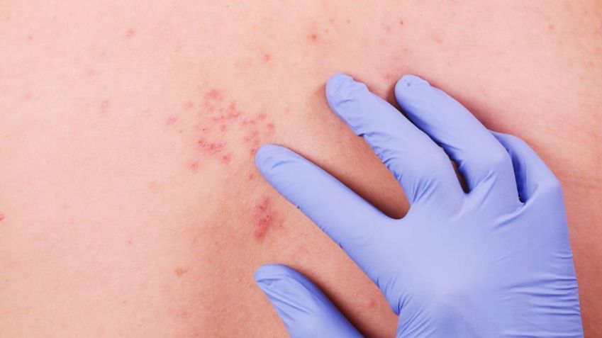 Diagnóstico de Herpes Zoster / Imagem: Shutterstock/pixfly