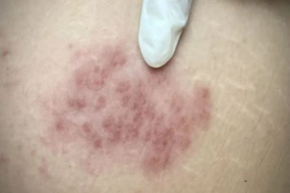 O que é herpes zoster, sintomas e possíveis tratamentos